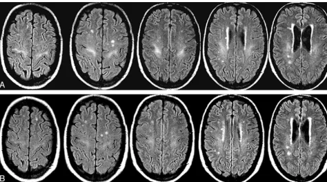 Fig 3. Aintensity along the corticospinal tract in both cerebral hemispheres., Transverse T2-weighted fast FLAIR images obtained in a patient with liver cirrhosis during an episode of hepatic encephalopathy