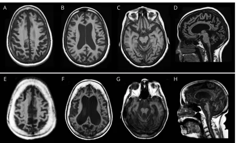 Figure 2 Representative axial and sagittal sections of T1-weighted brain MRIs