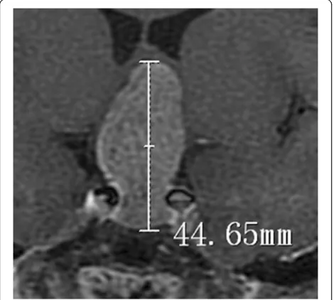 Fig. 1 Schematic diagram of the maximal tumor diameter evaluatedby enhanced coronal MRI (44.65 mm represents the maximumdiameter of this pituitary adenoma)