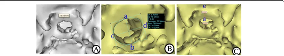 Fig. 2 CT 3-DR images revealing postoperative morphology of sellar floor and relevant parameters.78.85 mmab = 9.45 mm as the maximal vertical diameter of sellar floor opening, cd = 10.62 mm as the maximal transverse diameter of sellar floor opening, Area: 