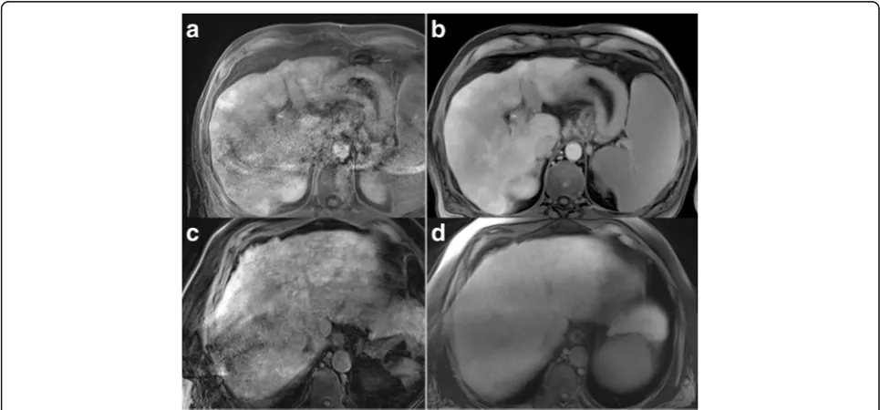 Fig. 4 In the direct comparison of CD-VIBE (visual lesion delineation (a, c) and radialVIBE (b, d), CD-VIBE shows higher intraparenchymal detail (blue arrows) as well as betterred arrows)
