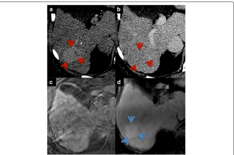 Fig. 6 Example of patient presenting with early enhancing (due to motion artifacts in this patient with impaired breath-holding capability
