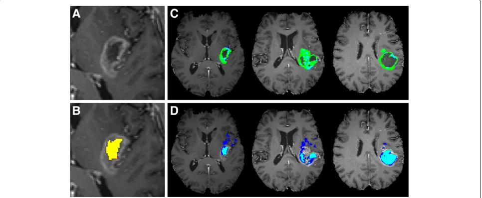 Fig. 7 Example of a bad segmentation result due to suboptimal voxel selection. A close-up of a GBM lesion on an axial T1C slice (necrotic region (segmented necrotic region is shown ina)