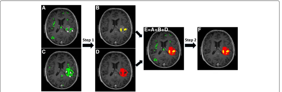 Fig. 1 Illustration of morphological post-processing after initial semi-automated NMF based segmentation of necrosiswithheld active tumor mask ( a and active tumor c