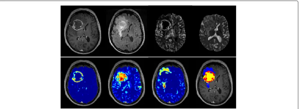Fig. 2 First row: coregistered MP-MRI maps of a GBM patient, left to right: T1C, FLAIR, rCBV, ADC