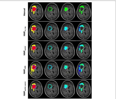 Fig. 3 Comparison of the segmentation results of the pathological tissue regions obtained for a GBM patient using the different NMF methodologies.The left figure of each row shows the obtained segmentation for active tumor (purple), necrosis (red) and edem