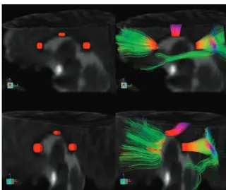 Fig 1. Localization of regions of interest. The upper row of images shows axial color-coded maps of FA with region-of-interest localization in the genu (left image), body (middle image),and splenium (right image) of the corpus callosum