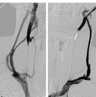 FIG 5. Selective catheterization of the azygos vein in a 45-year-oldpatient affected by relapsing-remitting MS