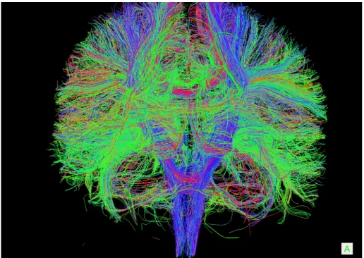 Figure 1.4: Diffusion MRI (Diffusion Tensor Imaging) tractography demonstration