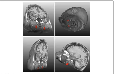 Fig. 9 Different views of segmented fat pads