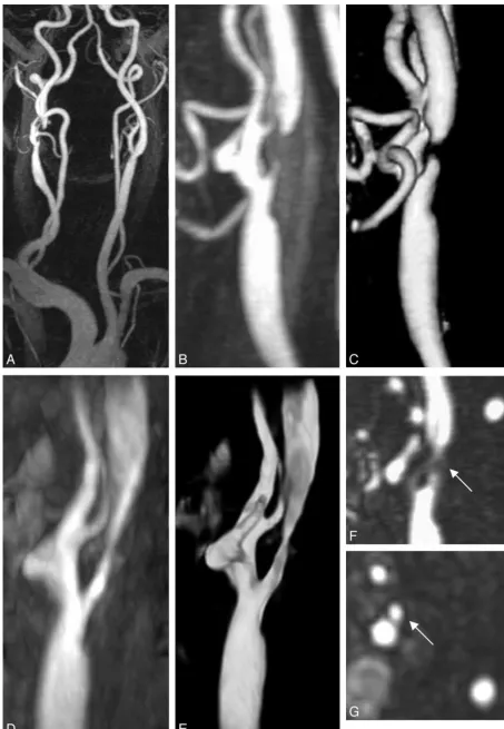 Fig 4. Stenosis of the right ICA.Eenhancement, but residual signal intensity is detectable with TOF-MRA ( A, An overview with the CE-MIP method