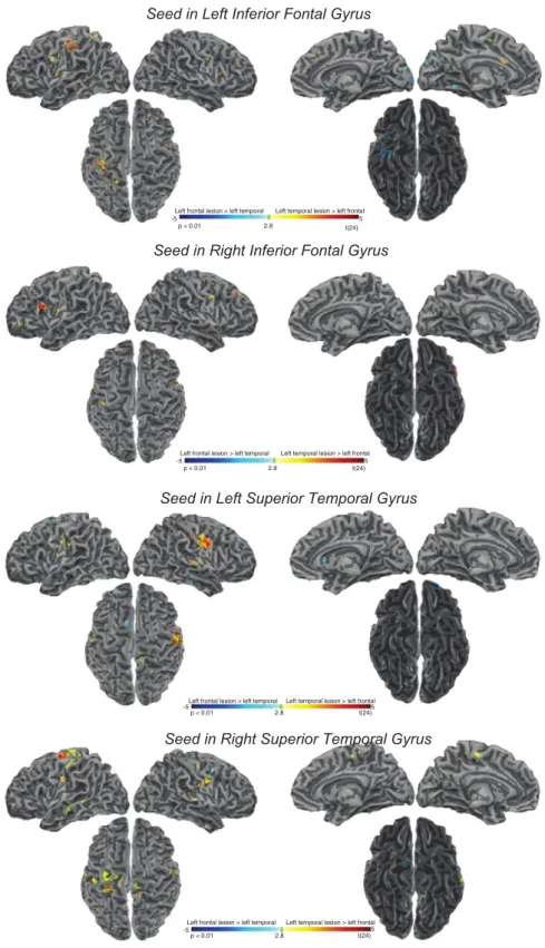 Fig. 6. Brain regions with higher FC in patients with left hemisphere lesions in the temporal lobes than frontal lobes