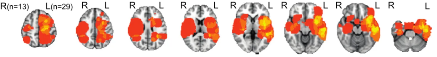 Fig. 1. Lesion overlap in patient group. Lesion masks in MNI space corresponding to all 43 patients