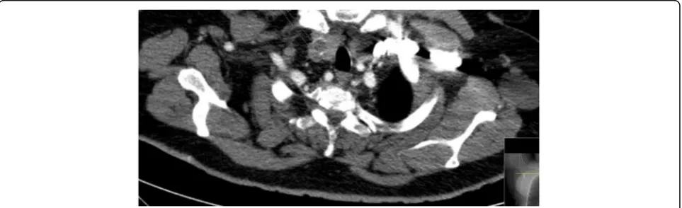 Fig. 1 The CT image shows two ROIs in the thyroid nodule. Abbreviations: CT, computed tomography; ROI, region of interest