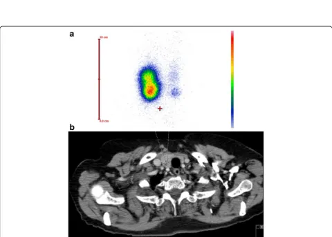 Fig. 2 TS shows an area with diminished uptake in the right lobe of the thyroid laterocaudal which is consistent with a cold nodule