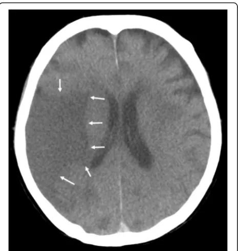 Fig. 1 Brain postmortem CT image 14 h after death (Case 1). AnLDA was found in the middle cerebral artery area (arrows)