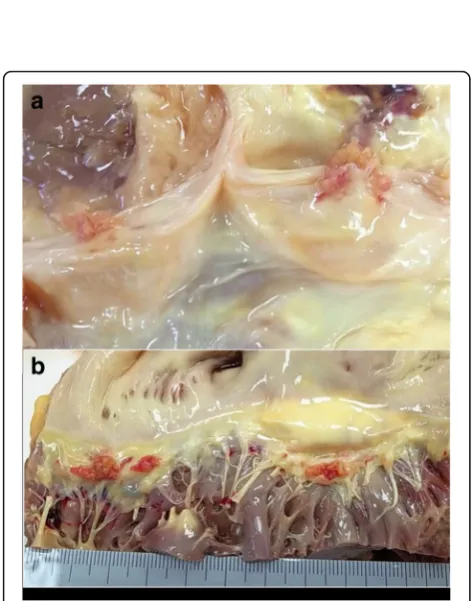 Fig. 5 The aortic valve and mitral valve at autopsy (Case 2). a The macroscopic appearance of the aortic valve