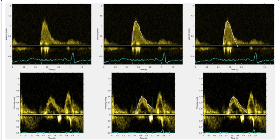 Fig. 2 Representative examples of Doppler velocity profile edge detection and the resulting fittedand curves for two different patients (top bottom, respectively)