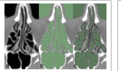 Fig. 5 Nasal cavity segmentation.under-thresholded segment of an axial CT image of a nasal cavity andadjacent sinuses