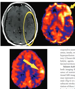 Fig 1. Luxury perfusion. Asymmetric intravascular enhance-ment of the cortical vessels in a large infarcted left MCAterritory (ellipse) on the postcontrast T1-weighted images.ASL CBF map demonstrates hyperperfusion in the left cau-date, insula, and frontal