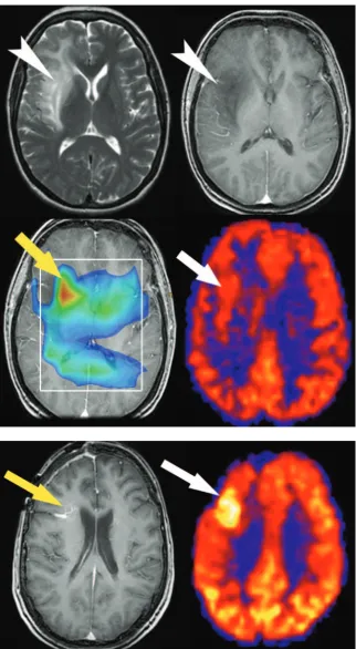 Fig 9. ASL hyperperfusion in infiltrative tumor. A 49-year-oldwoman who presented with seizures had an infiltrative T2(upper left) hyperintense lesion in the right frontal lobewithout significant enhancement on postgadolinium T1-weighted (upper right) imag