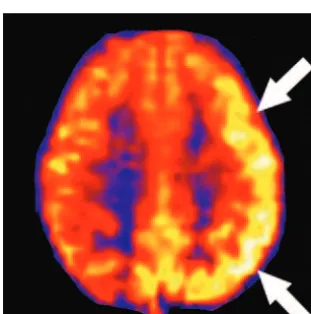 Fig 11. Evolution of perfusion changes in PRES in a 31-year-old woman.is now evident on perfusion images (right, A, Initial images: high signal intensity on the initial diffusion-weighted image (left) represents T2 shinethroughsecondary to edema seen on th