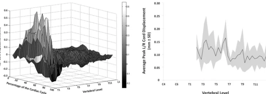 Fig 4. The peak L/R spinal cord displacement averaged across all of the subjects andplotted as a function of R/C cord position (ie, vertebral level)