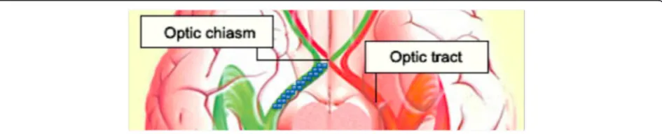 Fig. 2 Schematic illustration of an ROI (blue squares) of the left optic tract. All ROIs aimed to start at the posterior part of the optic chiasm and toinclude the central portion of the optic tract