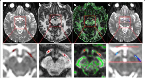 Fig. 3 Illustration of the four ROI methods (upper row: axial slices of whole MRI images; lower row: close-ups of the optic tracts and ROIs)