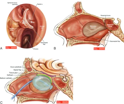 FIG 1. Multilayer ESBR using NSF.is anchored by its pedicle (substitute (such as collagen matrix, fascia lata) and onlay mucosal closure with an NSF (labeled as a septal ﬂap)