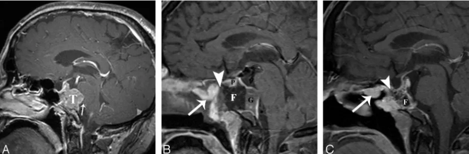 FIG 3. A 47-year-old man with normal evolution of the ESBR after EEA gross total resection and adjuvant radiation of a clival chordoma.hancing fascia lata (reconstruction with the enhancing fascia lata (pituitary (P).postoperative sagittal enhanced fat-sat