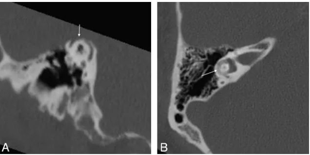 FIG 9. Axial CT in a 41-year-old man with vertigo and complete sensorineural hearing loss inconsistent with intravestibular footplate dislocation.same patient as in A,the left ear after prior stapedectomy show focal hyperattenuation in the vestibule (arrow), B, Coronal multiplanar reformation in the A shows intravestibular footplate dislocation (arrow).