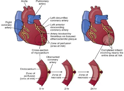 Figure 4: Evolution of Myocardial Infarction 
