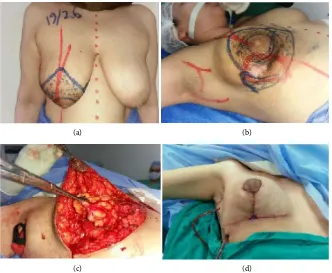 Figure 1. (a) Preoperative marking; (b) Locally advanced breast cancer in LOQ; (c) The Tumor resected with displacement by pedicled flaps; (d) Final results