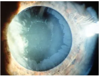 Figure 1.Pseudo exfoliation in pupillary margin 