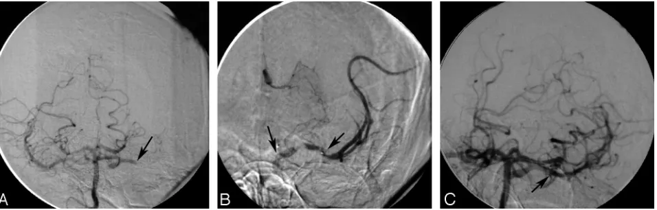 Fig 1. AB, The right vertebral artery injection shows bilateral filling of the PcomA arteries that supply both internal carotid arteries