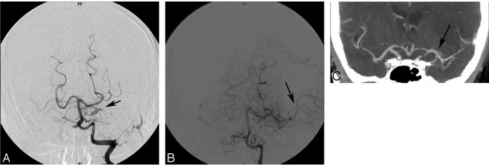 Fig 2. ACT angiogram 24 hours after stroke shows a complete recanalization of the M1 segment of the left MCA (by use of the AcomA and PcomA arteries resulted in partial lysis of thrombus in the left M1 segment with restoration of flow within the inferior d