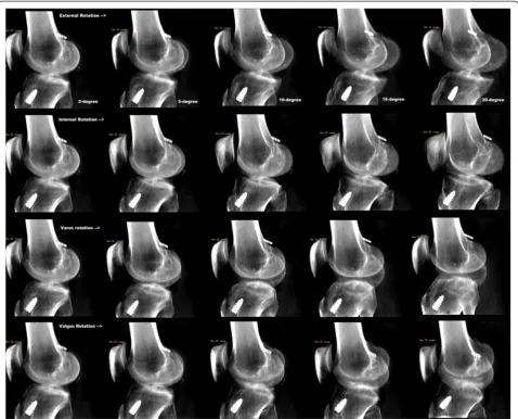 Table 1 Inter-observer variability and standard error of measurement of quadrant methods for evaluation of tunnel aperture orificeafter anatomic single-bundle anterior cruciate ligament reconstruction