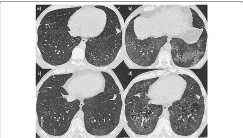 Fig. 3 Patient 2. Radiological evolution. Axial CT images of the lung.more obvious ground glass infiltrate