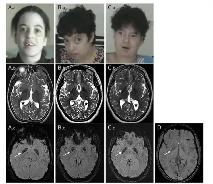 Figure 2 Facial appearance and brain imaging