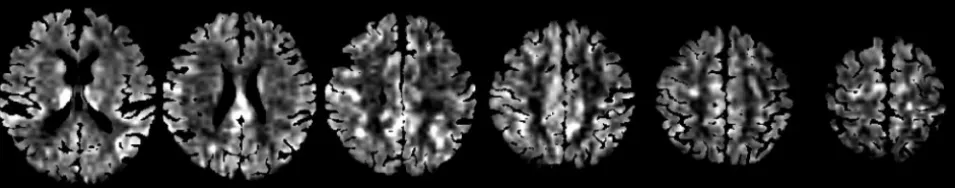 Fig 1. CBF images representing the 6 analyzed sections from subject 4.