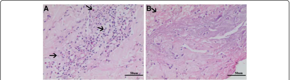 Fig. 3 Skin biopsy: a Infiltration of eosinophils, neutrophils, and lymphocytes presented in the vasculature and interstitial spaces of the dermal layer(arrows; HE staining; magnification 200×); b The arrow showed focal fibrinoid necrosis in the reticular dermis (HE staining; magnification 200×)
