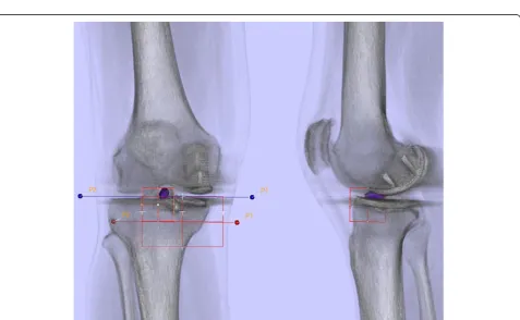 Figure 2 Determination of UKA component position in 3D reconstructed CT images using a customized software.