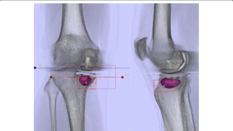 Figure 4 Bone tracer uptake quantification of a SPECT/CT in standardized anatomical areas in a symptomatic patient with tibialloosening five year after UKA.