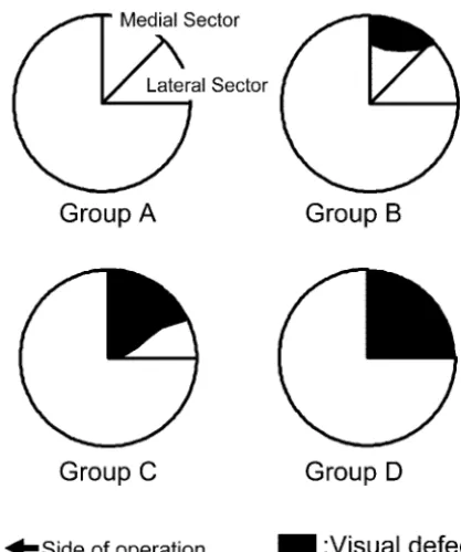 Fig 1. Schematic drawing of the classification by visual field defect. Fibers in the anteriorpart of the Meyer loop correspond to the medial sector, and posterior fibers correspond tothe lateral sectors of the upper quadrant visual field on the contralater