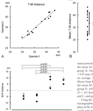 Fig 5. Interindividual variation of the T-M distance. A, Thereproducibility of tractography by 2 operators