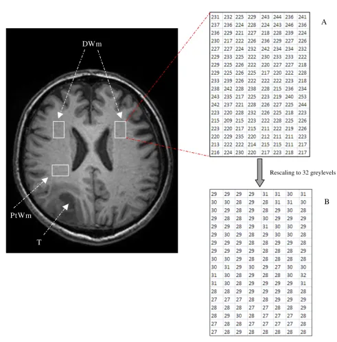 Figure 1MR image of brain glioblastoma and the surrounding white matteroriginal ROI which has a dynamic range from 0 to 255 greylevels