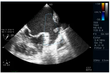 Figure 4: TDI of Lateral Mitral Annulus