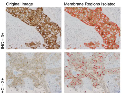 Figure 5 shows the variations in staining intensities of themembrane regions of known HER2 positive controls(taken from breast specimens that are FISH positive andpreviously manually scored as 3+) used in this study.Though most control specimens stain dark