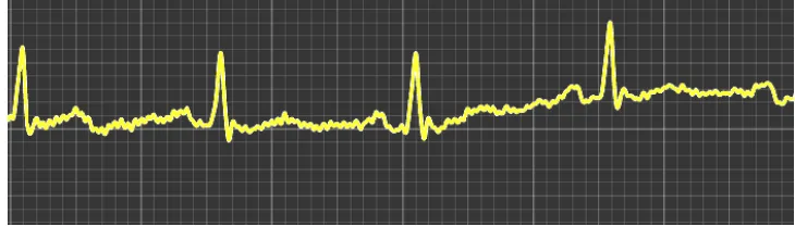 Figure 2: ECG of subject 1 after consuming Ashwagandha for 1 month The ECG of subject 1 was recorded again after the consumption of Ashwagandha for 1 month.